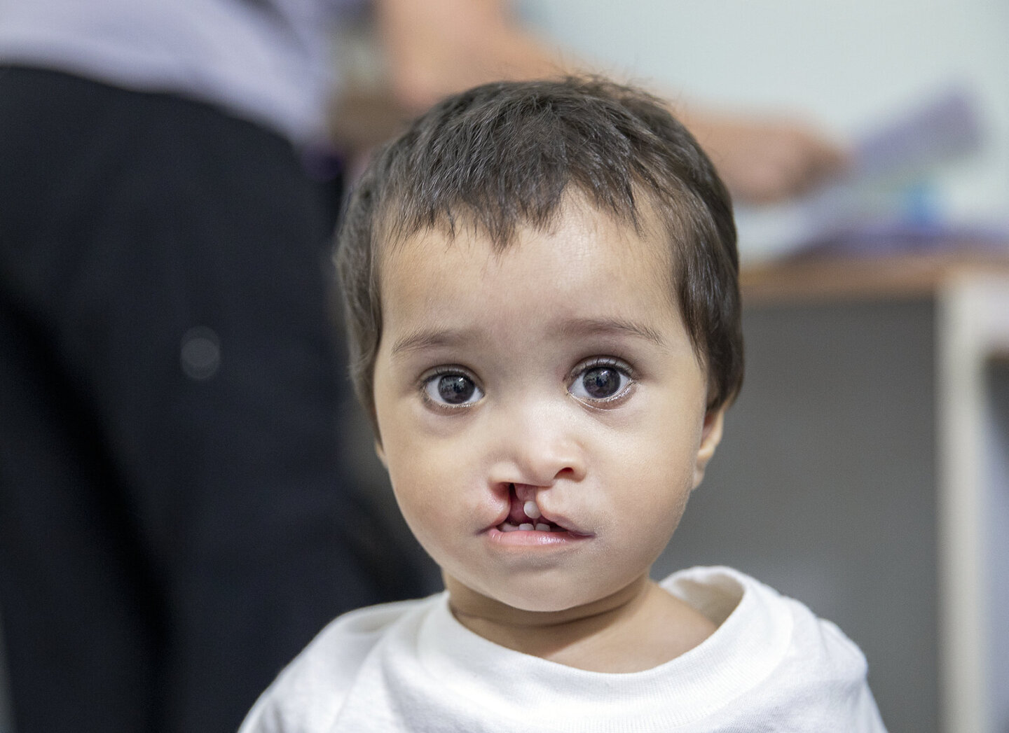 Meet 6-month-old Dilfa, before sugery.