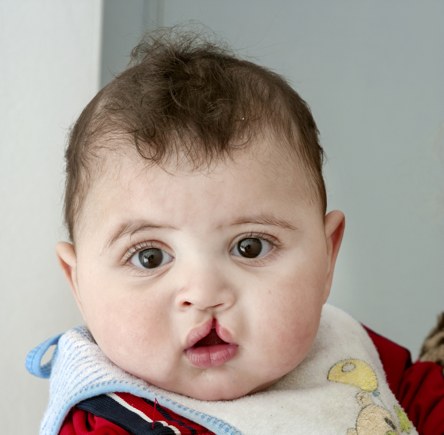 Mohamed, before surgery.