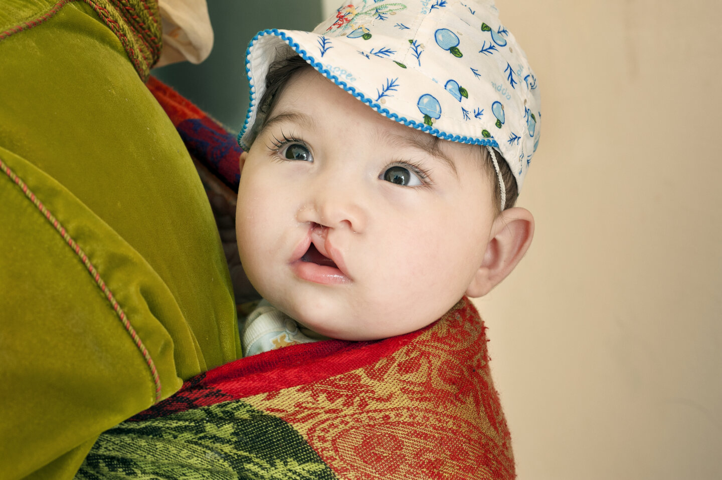 Six-month-old Rania, before surgery.