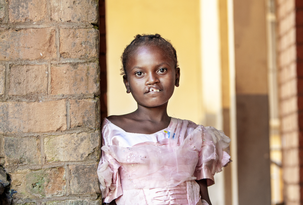 Twelve-year-old Sandra before cleft surgery