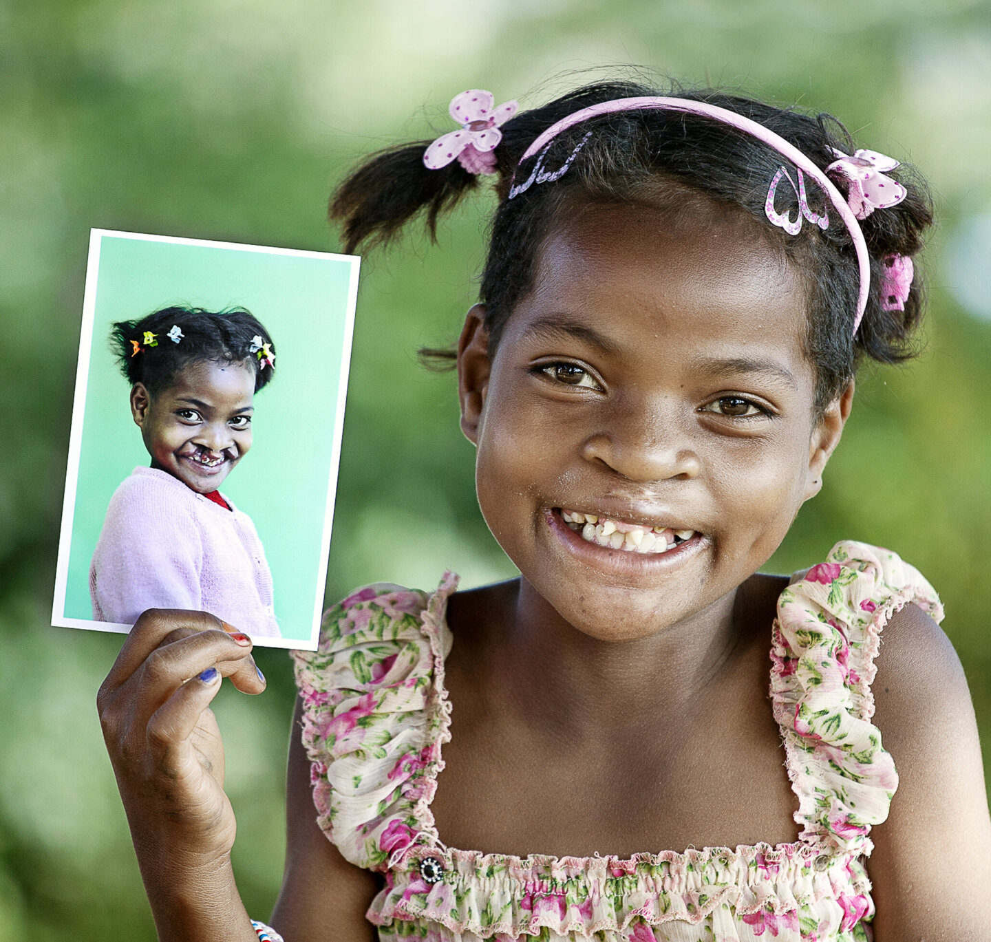 Clara shares her new smiles after her life-changing cleft surgery.