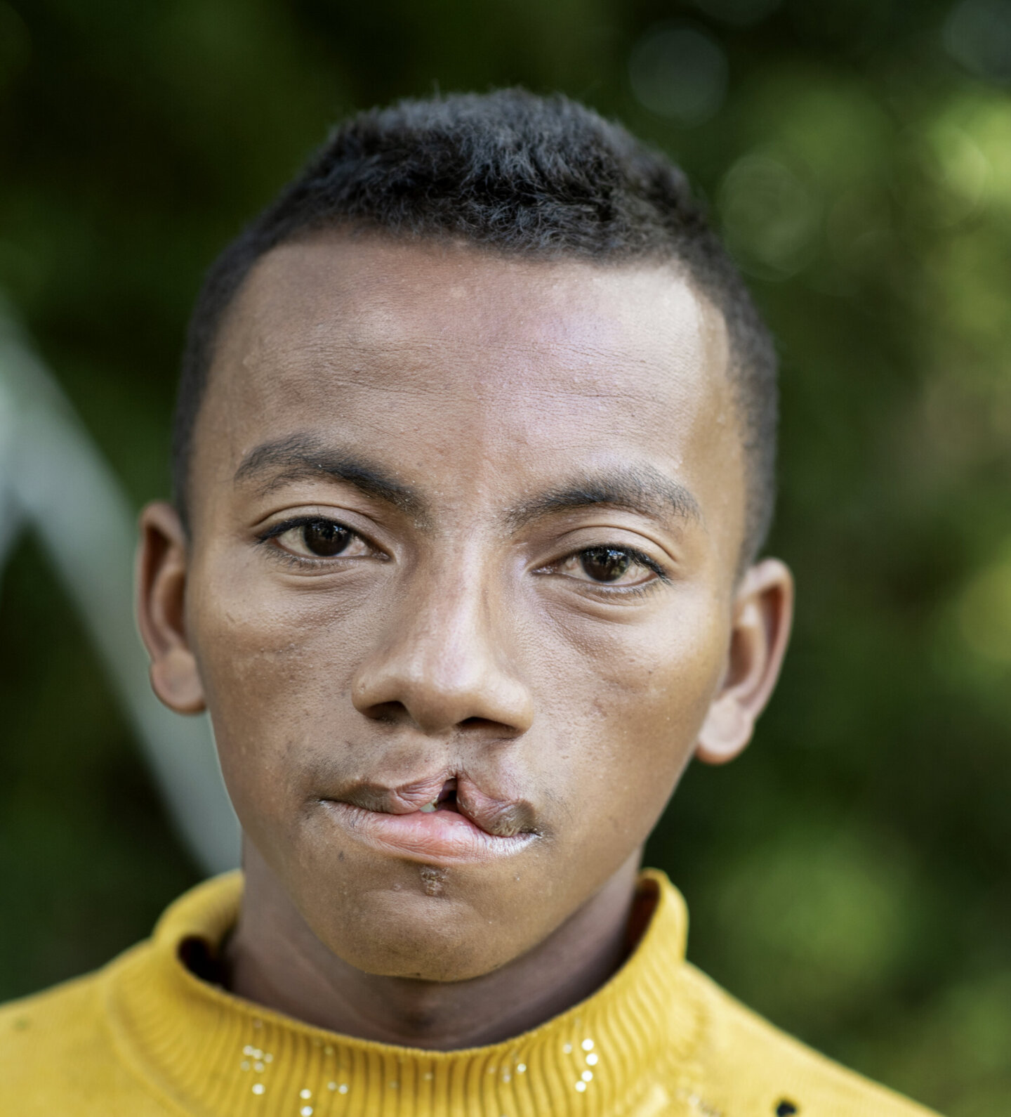 Herve lived with an untreated cleft lip for 24 years before learning about Operation Smile Madagascar from Fidelis.