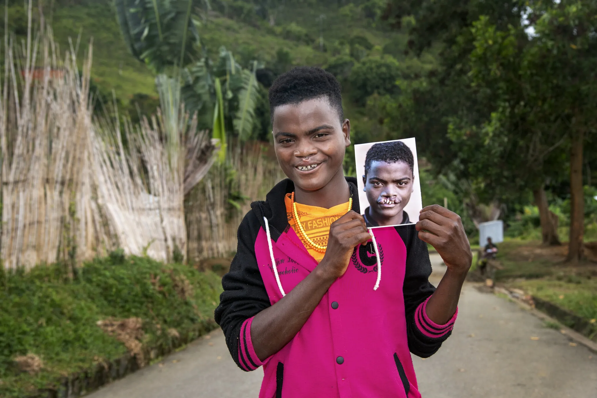 Roman, after surgery, holds his before photo.