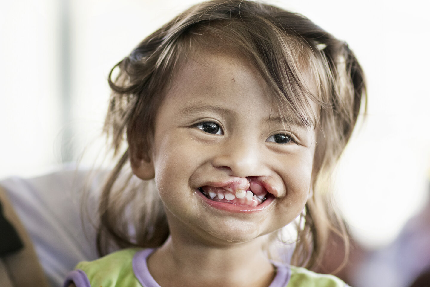 Karla, before surgery.