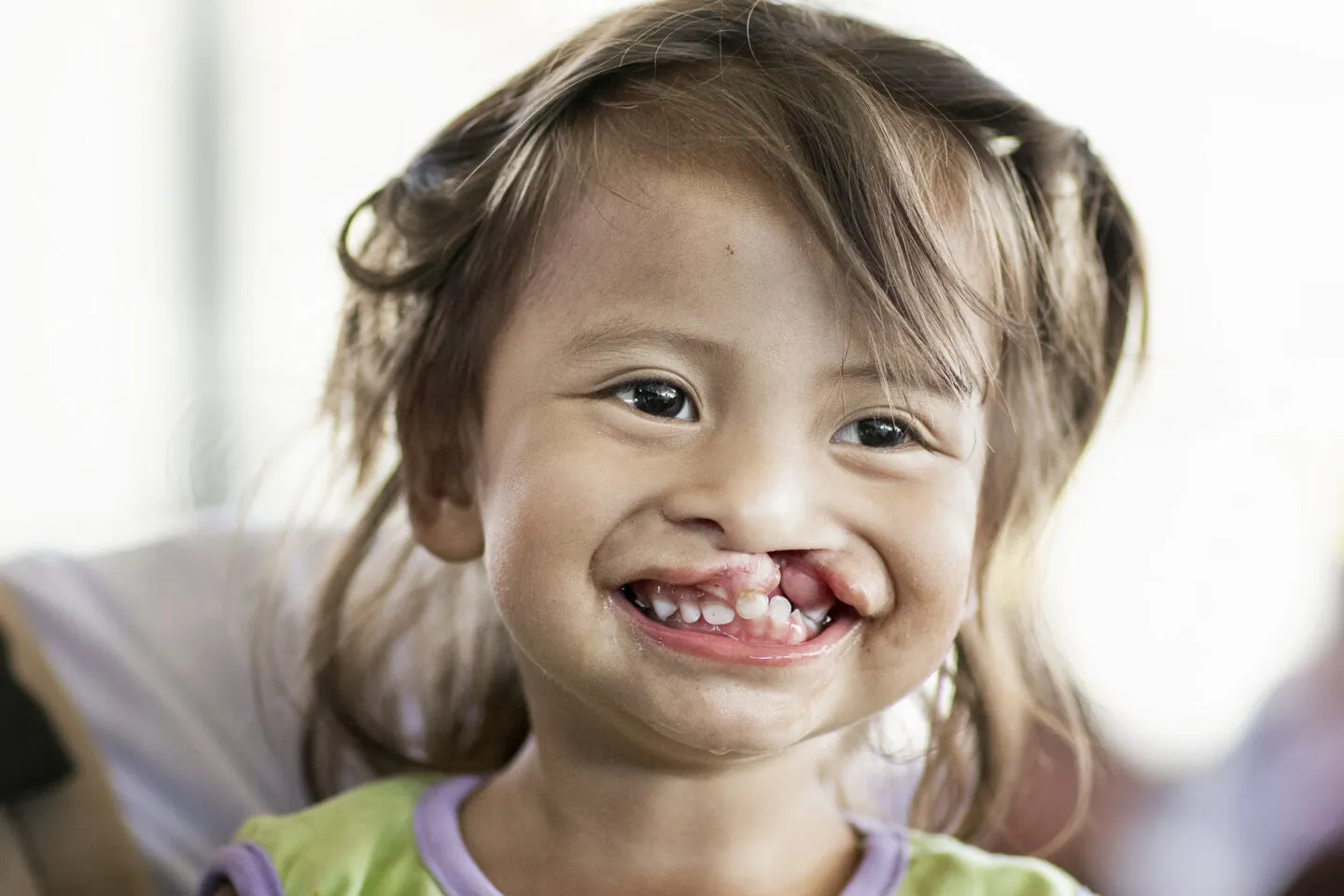 Karla, before surgery.