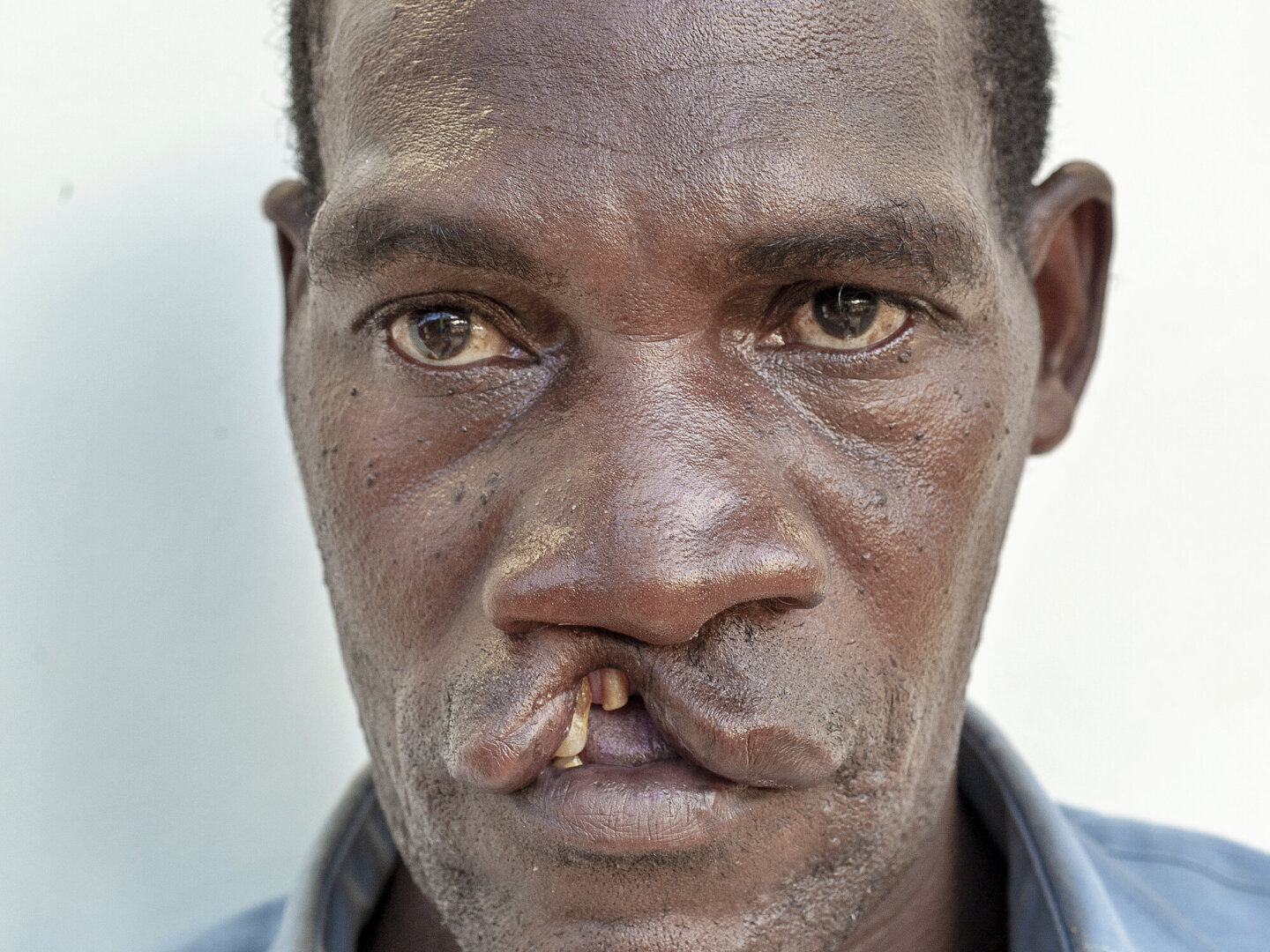 Domingos, before surgery.