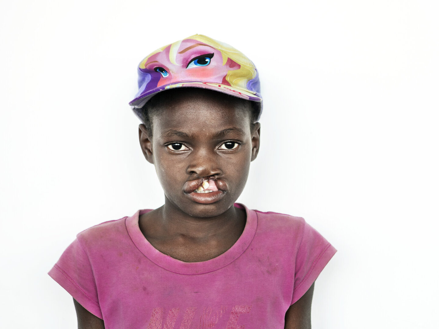 Noemia, before surgery.