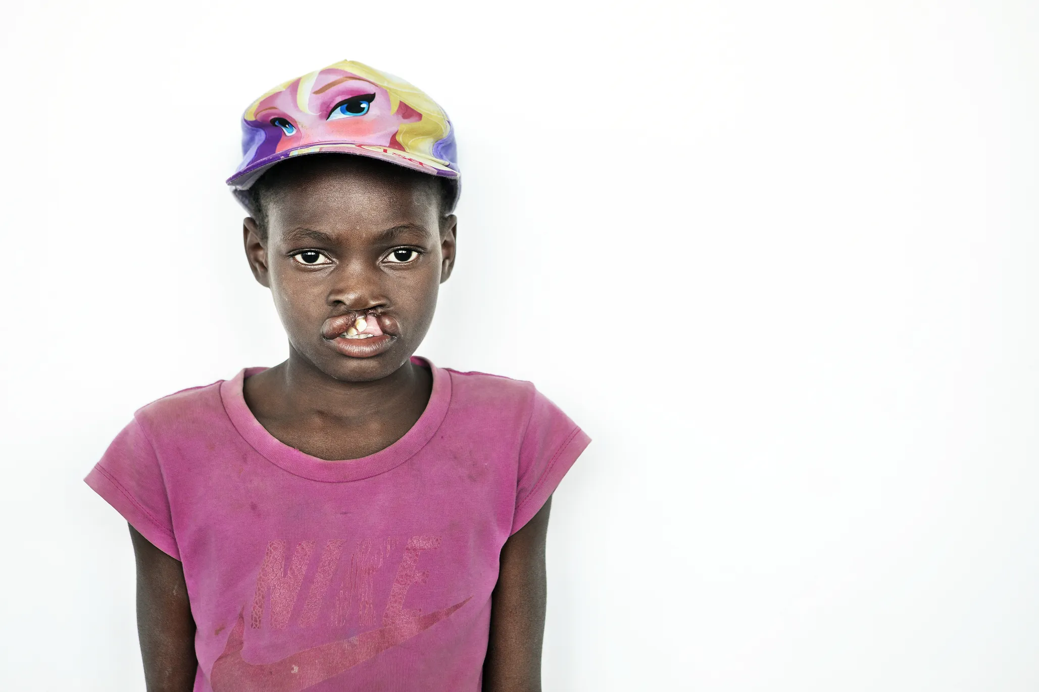 Noemia, before surgery.