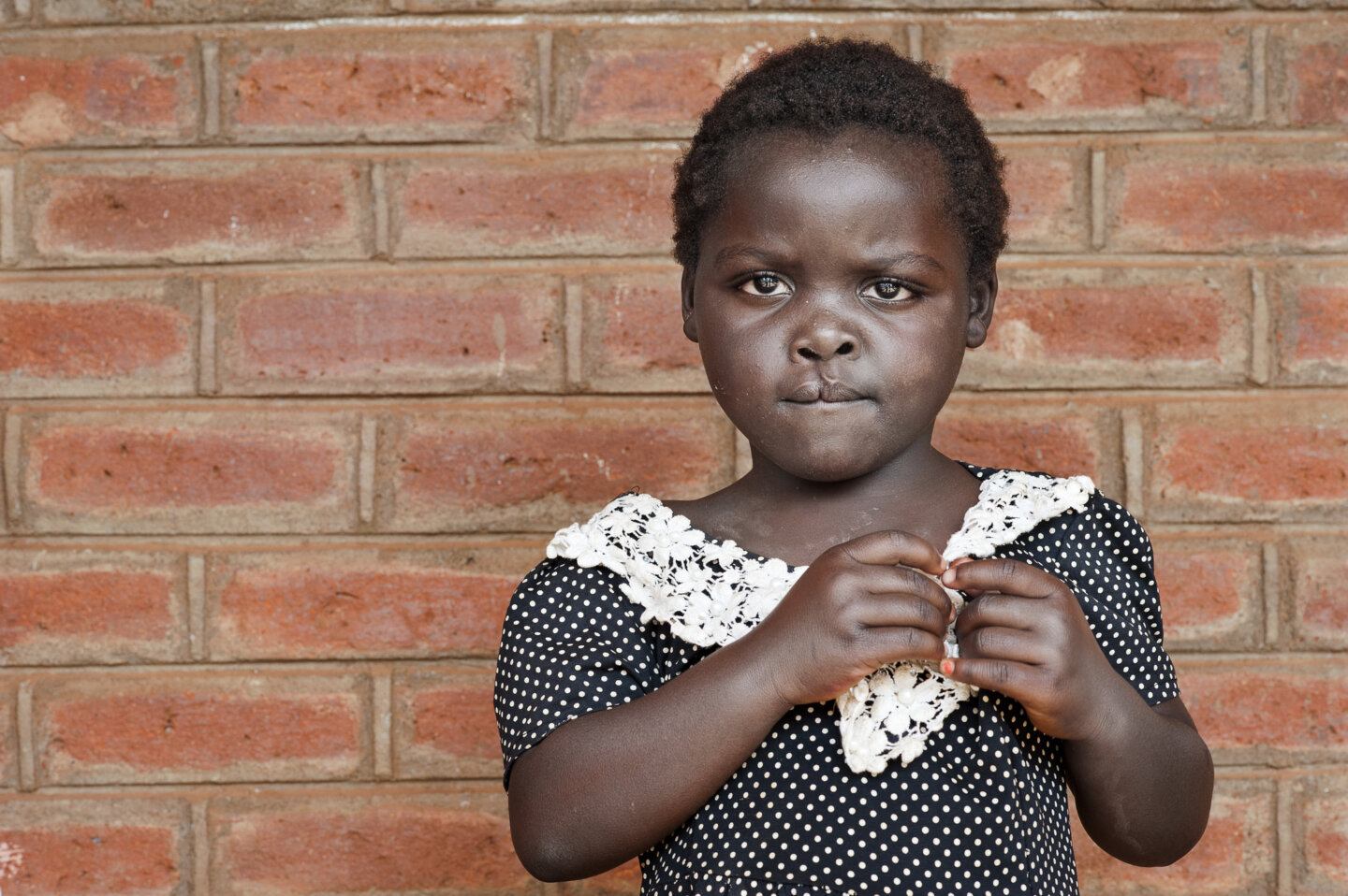 Four-year-old Ziyalesi, before surgery.