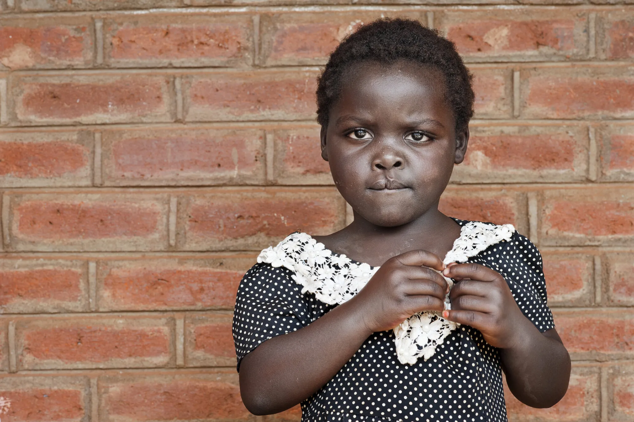 Four-year-old Ziyalesi, before surgery.