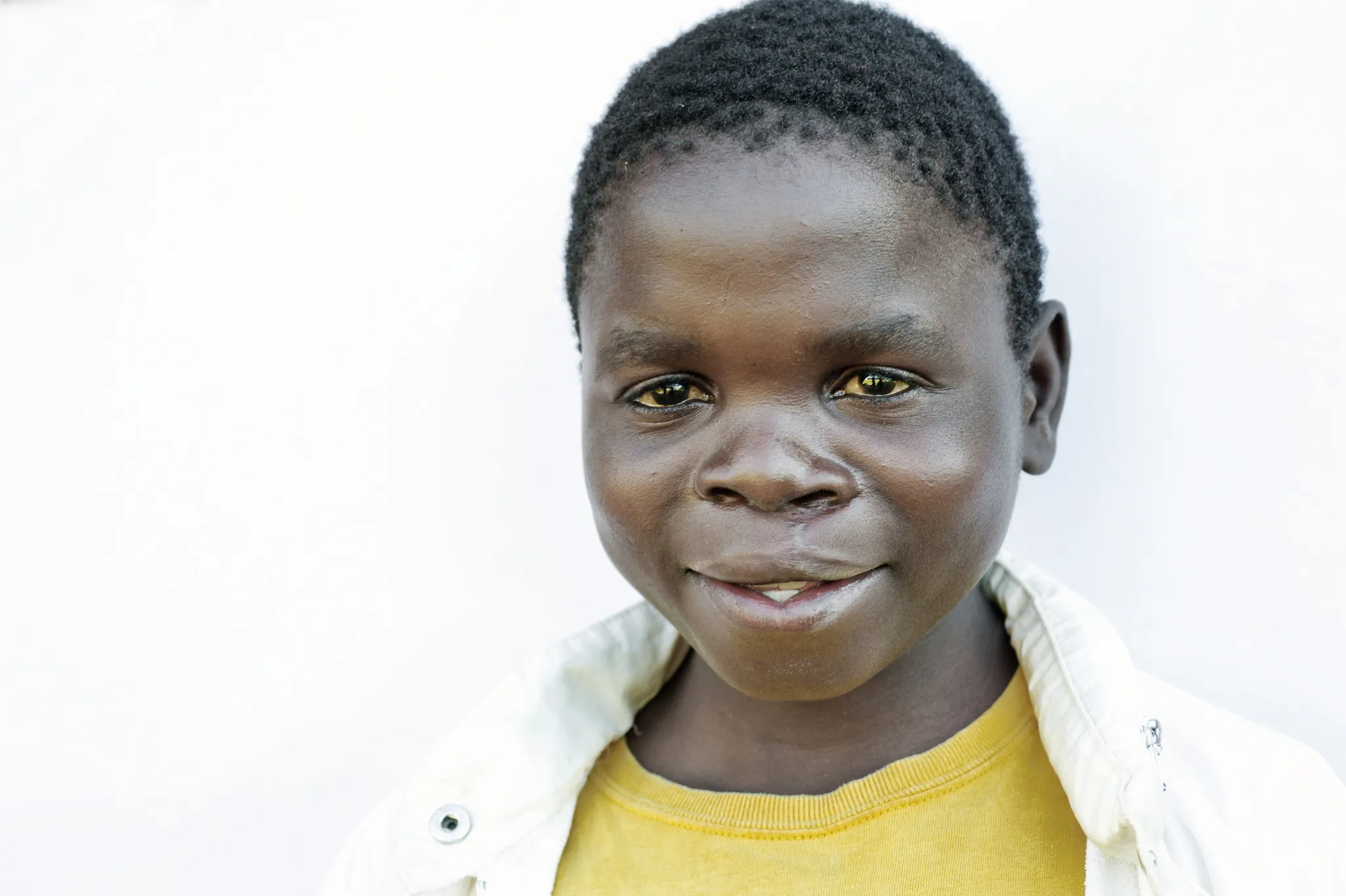 Cosmas, one year after his surgery.