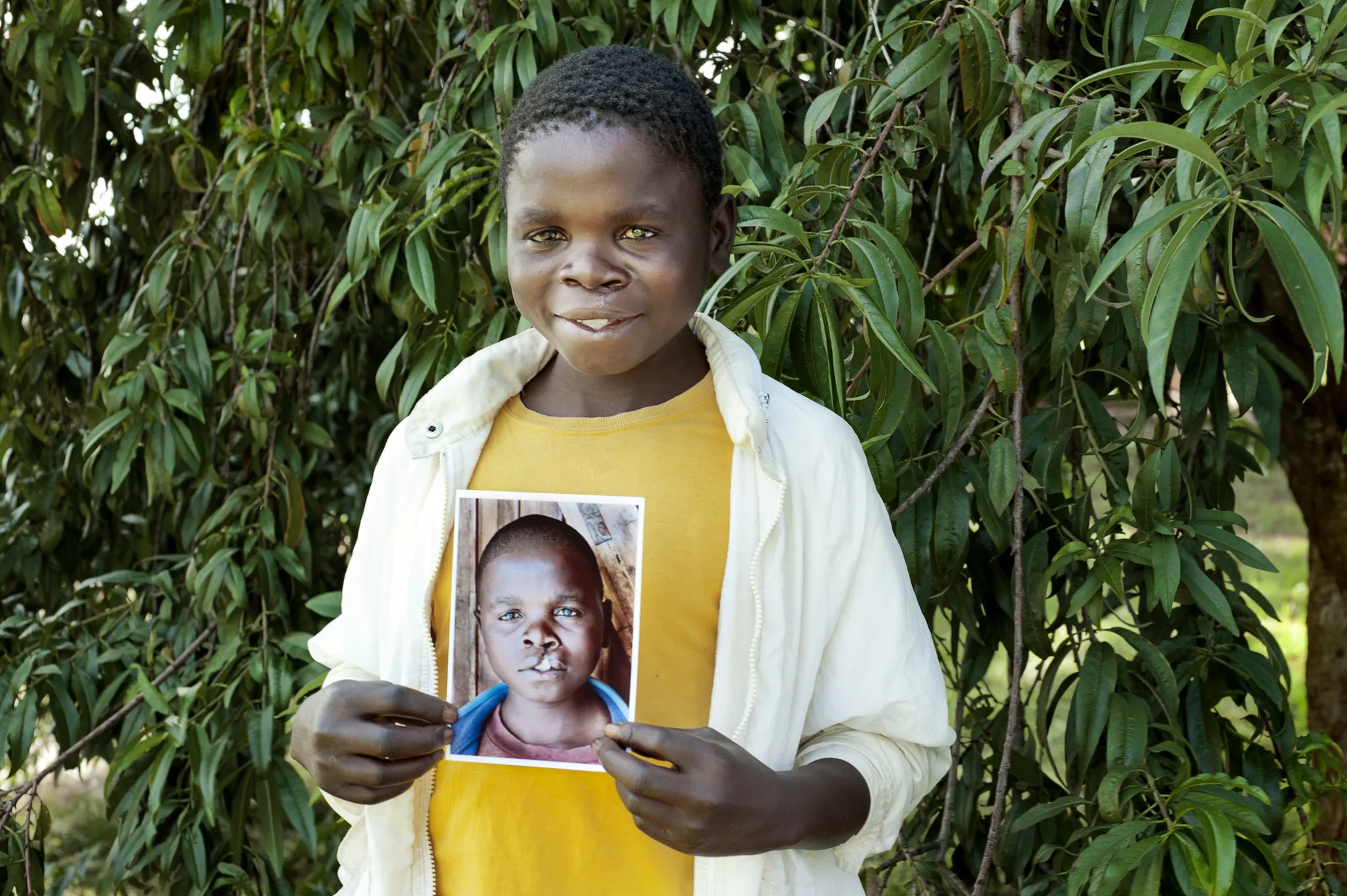 Cosmas, one year after his surgery.