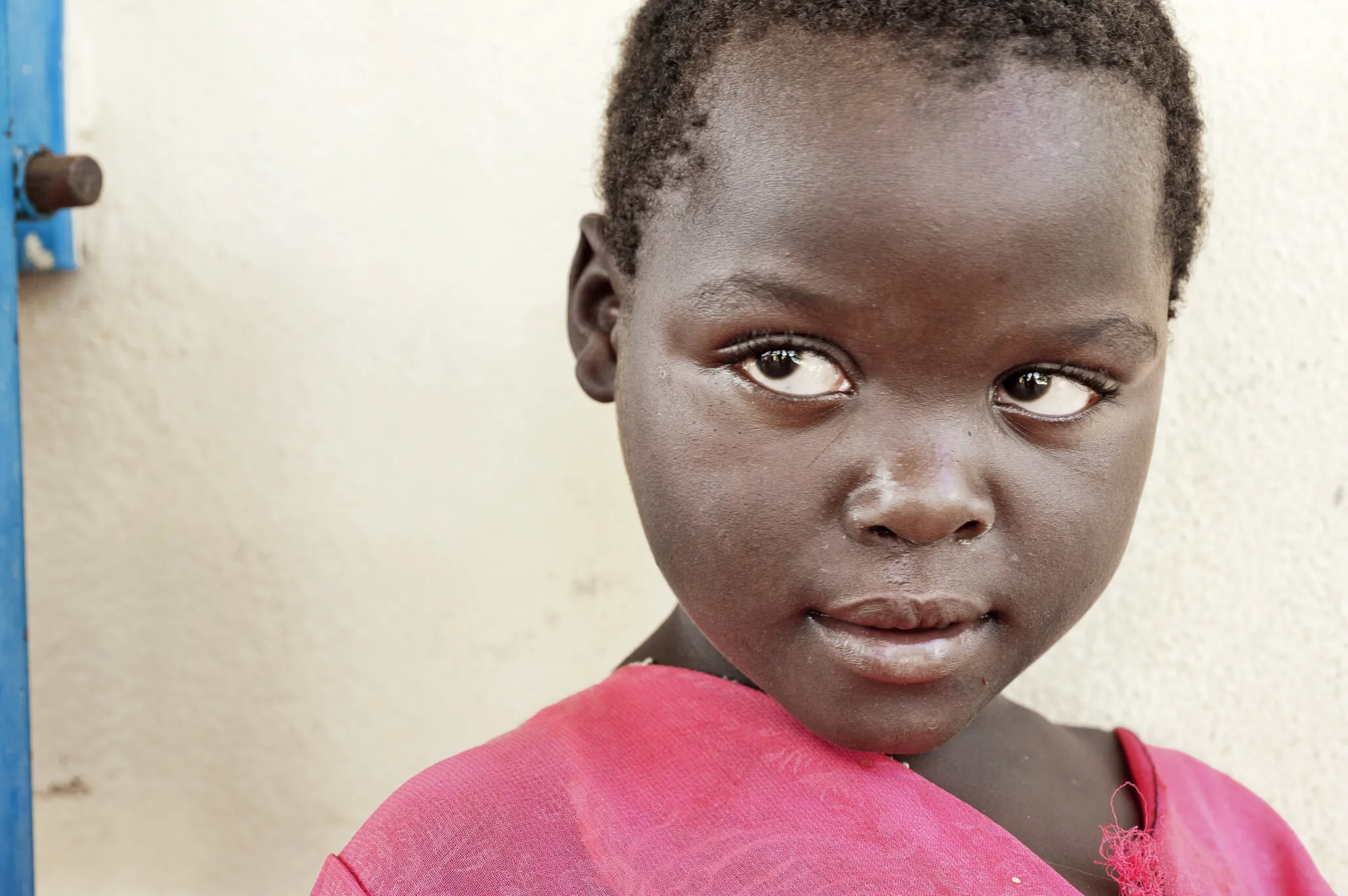 Ziyalesi, one year after cleft surgery.