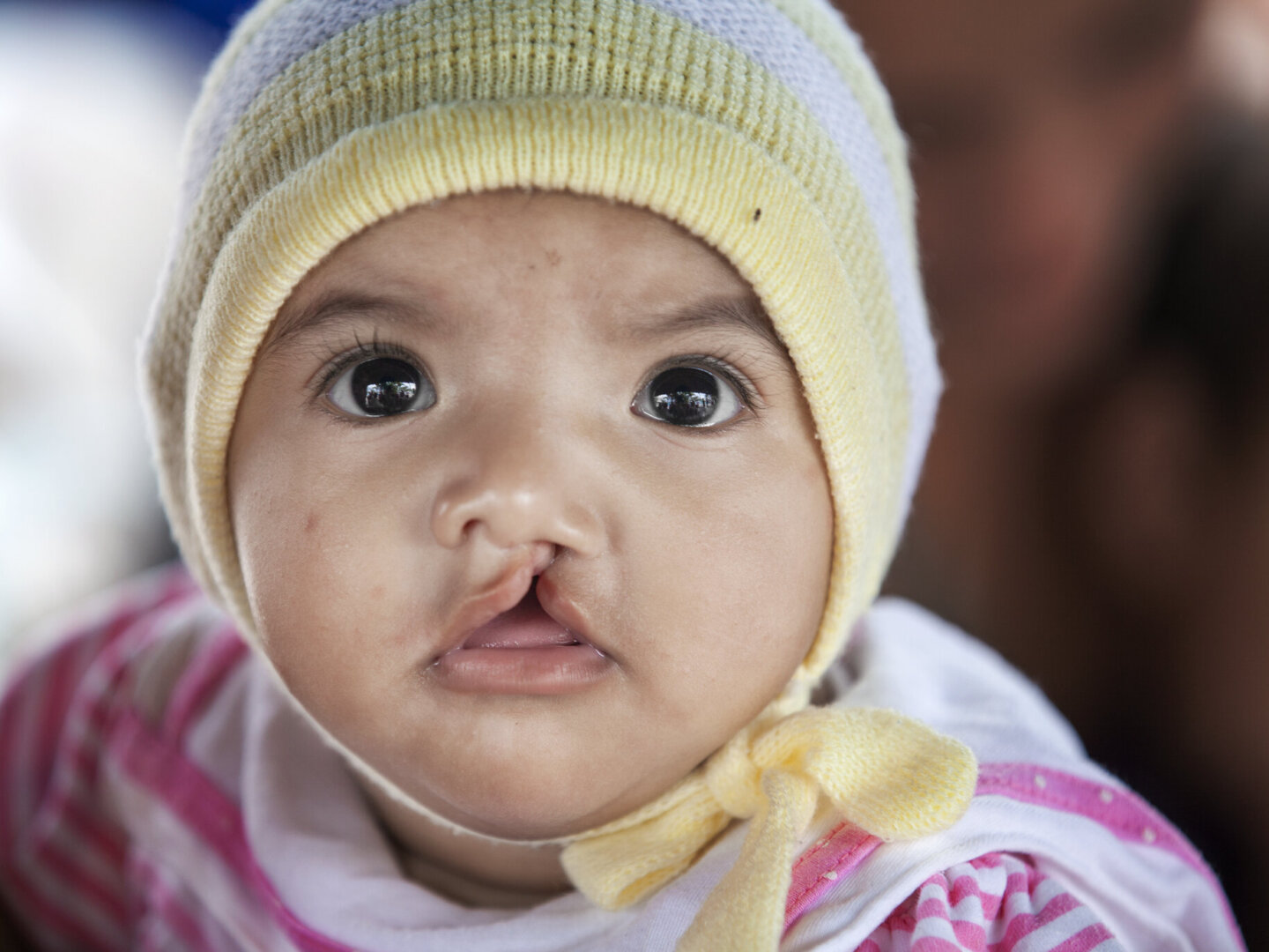 Marianna, before surgery.