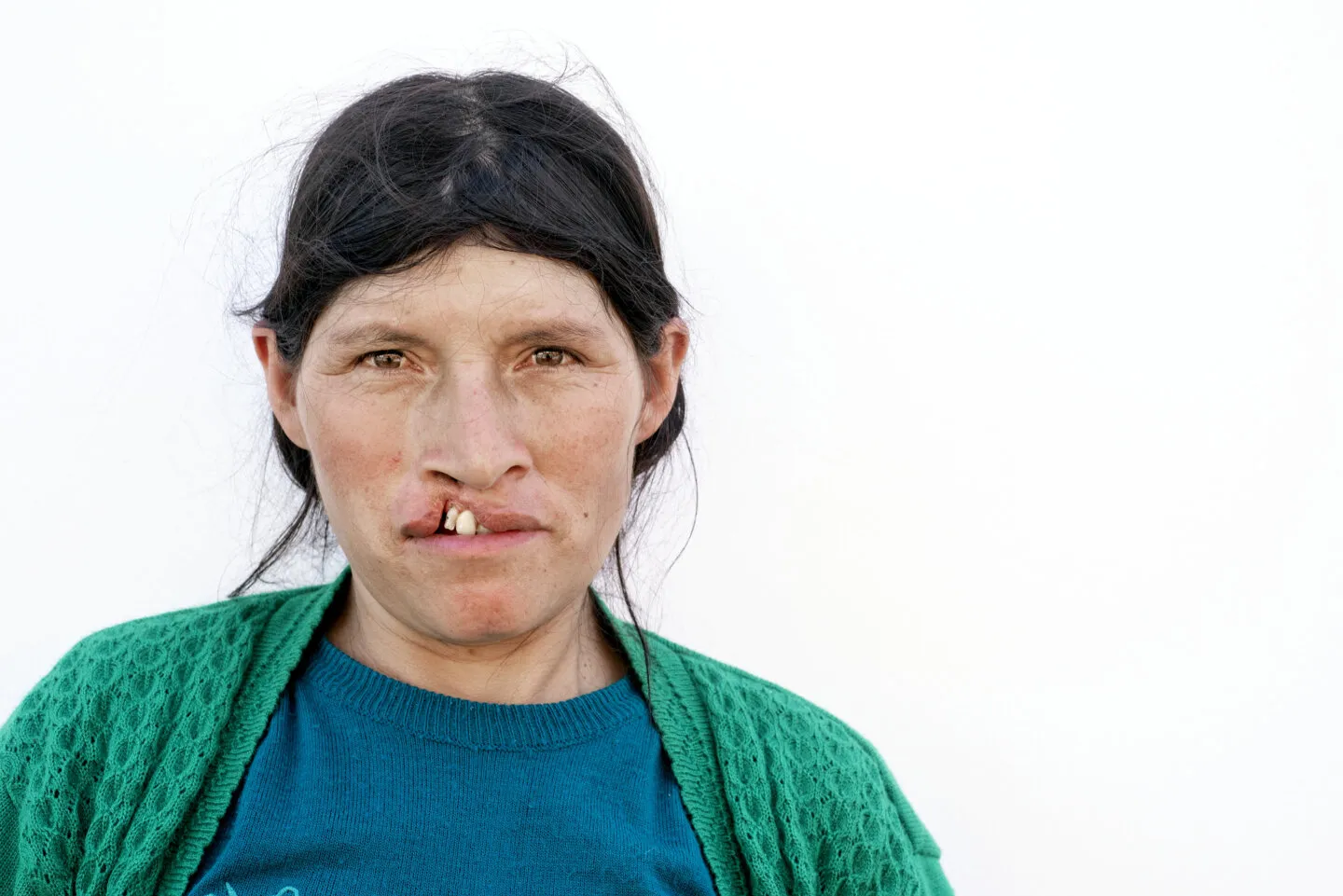 Andrea, before surgery.