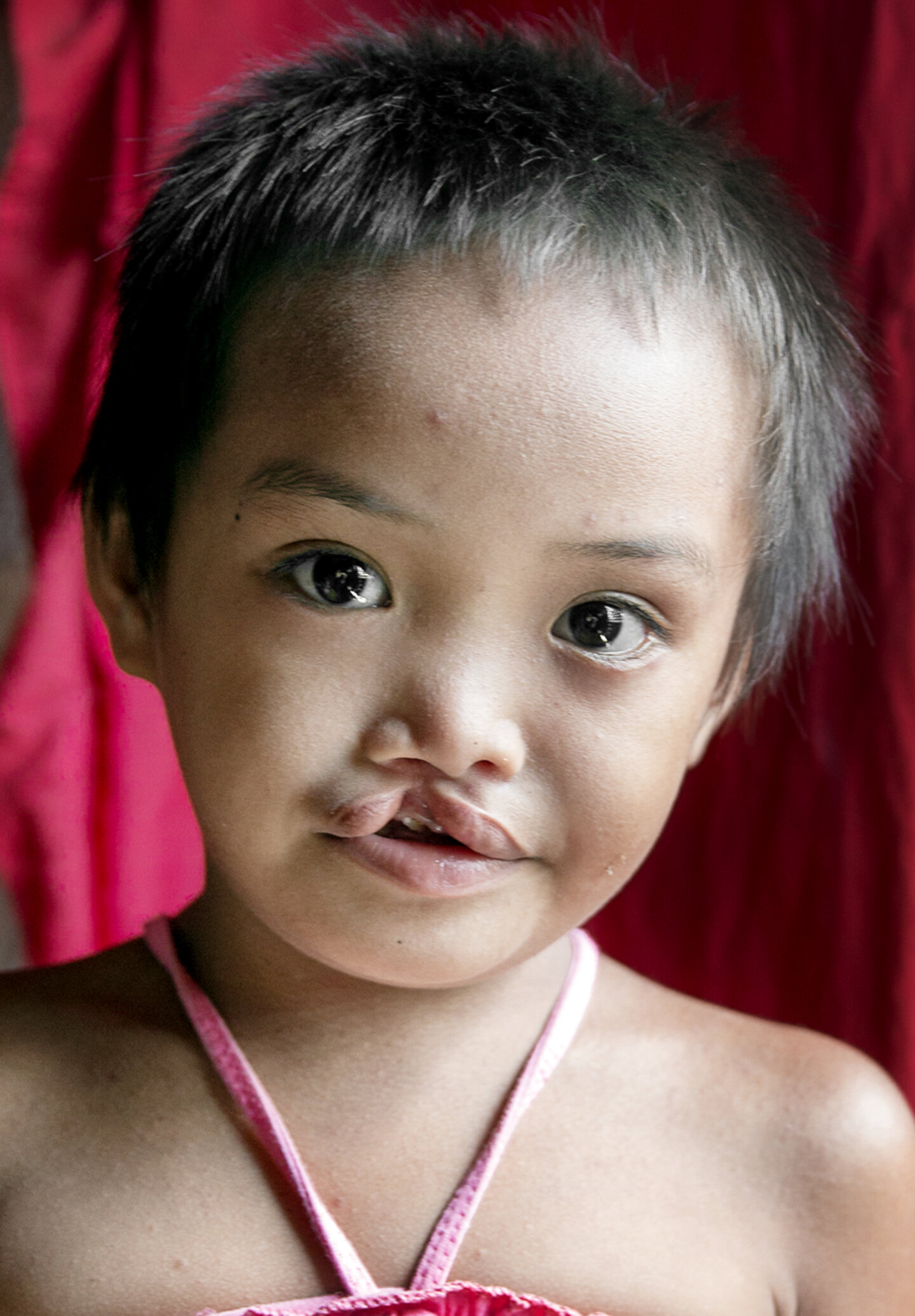 Seven-year-old Jane Rose, before surgery.