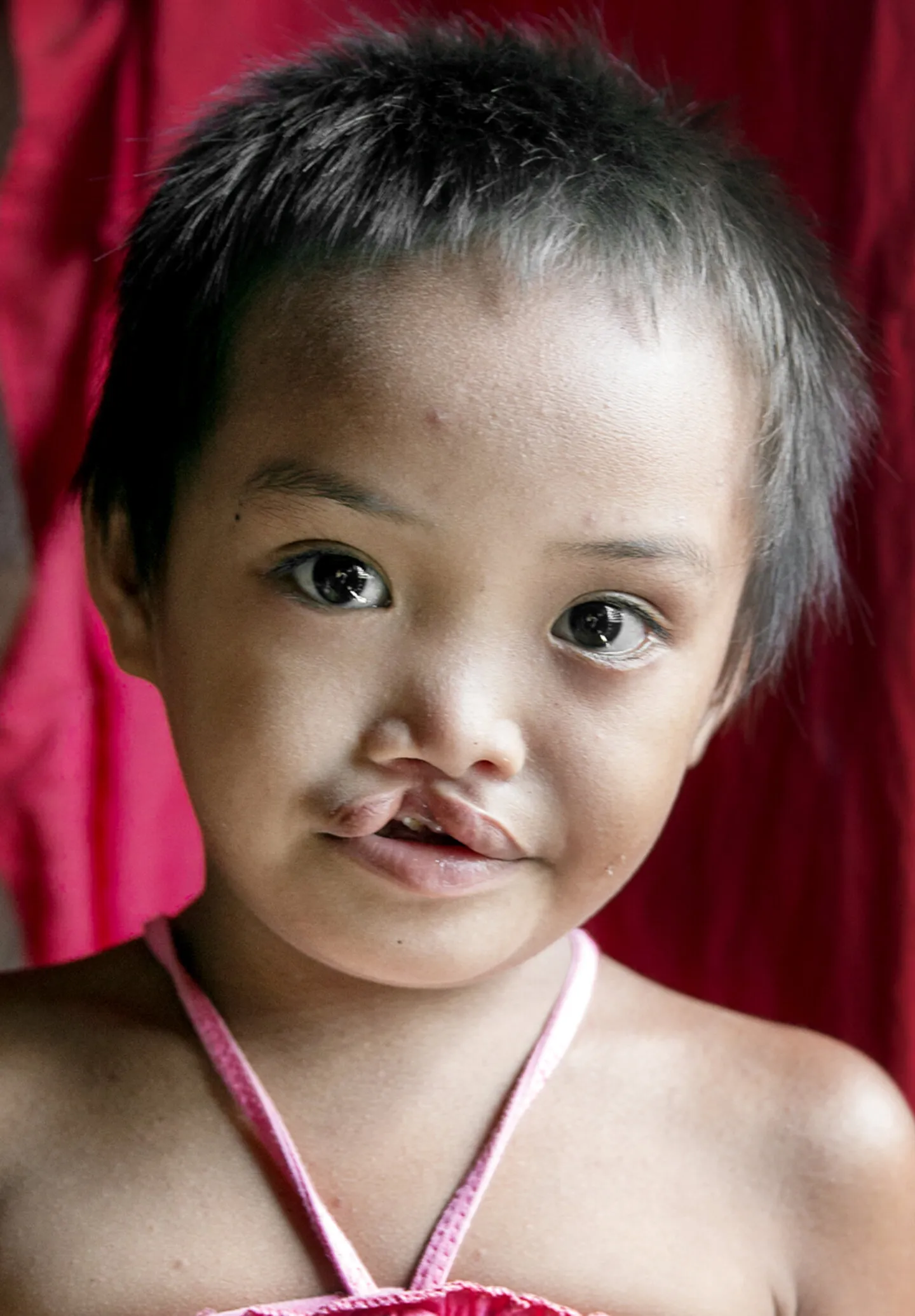 Seven-year-old Jane Rose, before surgery.