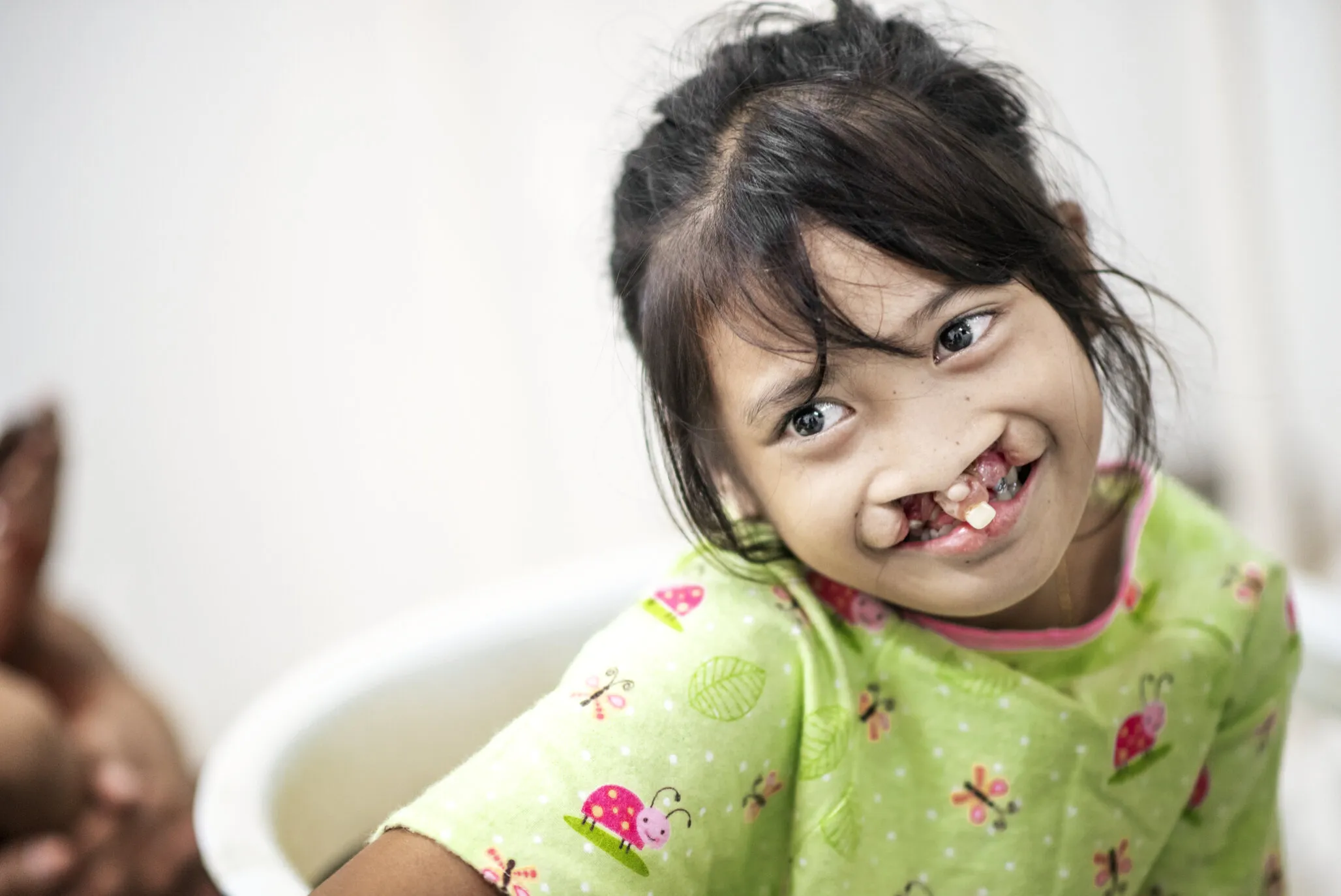 Kisha smiles at the camera, before surgery.