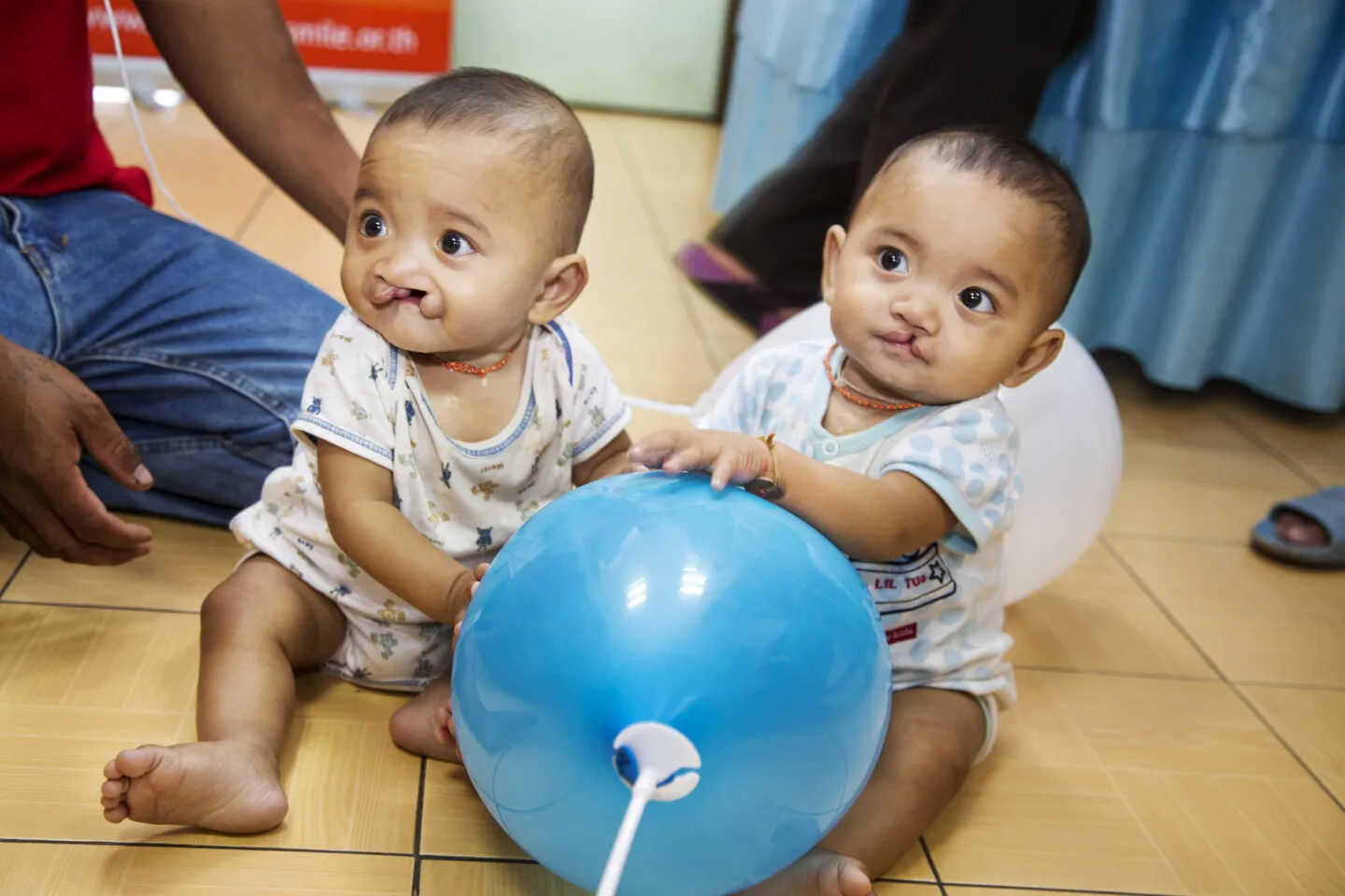 Ou, left, and Lak, before surgery.