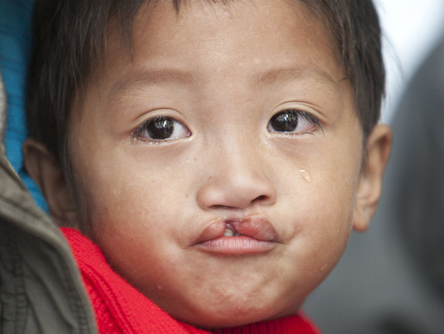 Bui, before surgery.