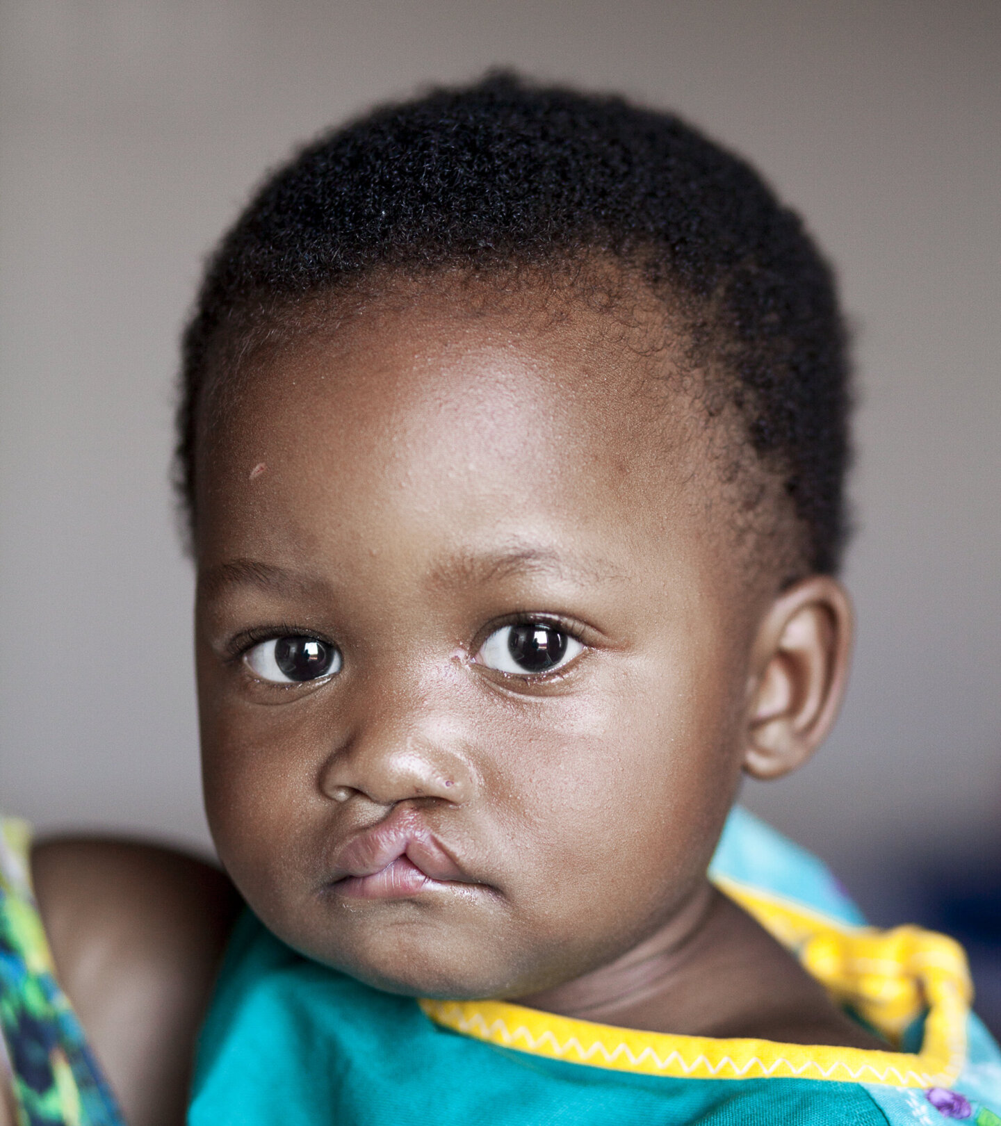 Lungile, before surgery.