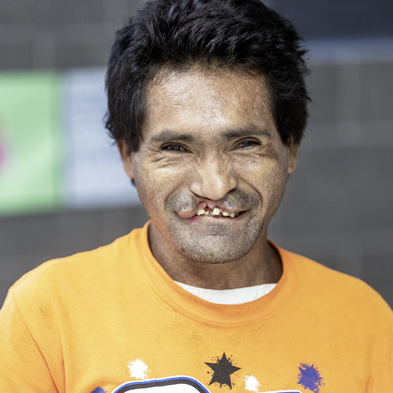 Adelmo, before surgery