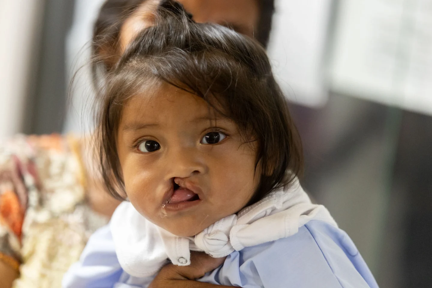 Jhon looks at a camera during a surgical program in Peru.
