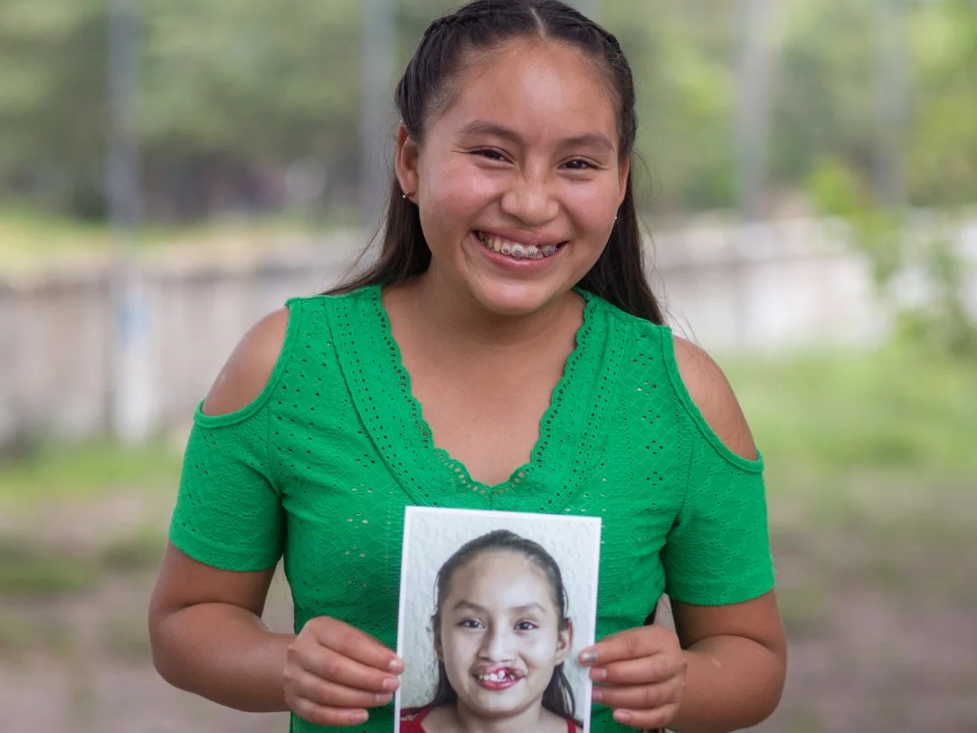 Dayana, a teenager from Guatemala, smiles at the camera while holding a photo of herself before her cleft surgery. Her long black hair is pulled back from her face, and she wears a bright green shirt.
