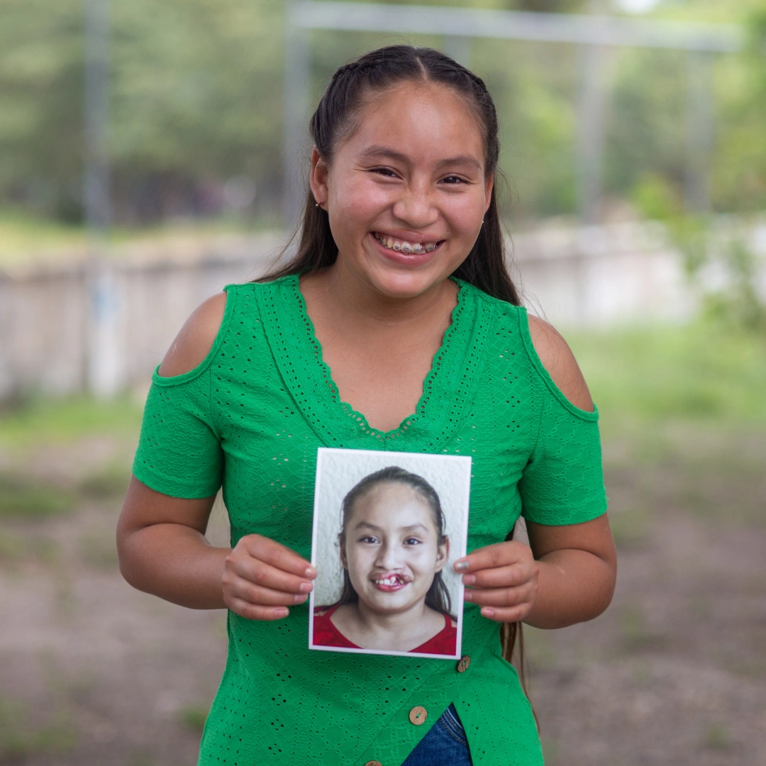 Dayana, a teenager from Guatemala, smiles at the camera while holding a photo of herself before her cleft surgery. Her long black hair is pulled back from her face, and she wears a bright green shirt.